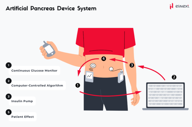 Automated Insulin Delivery (AID)